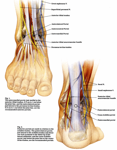 Ankle Arthroscopy