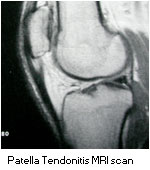 Chondromalacia Mri